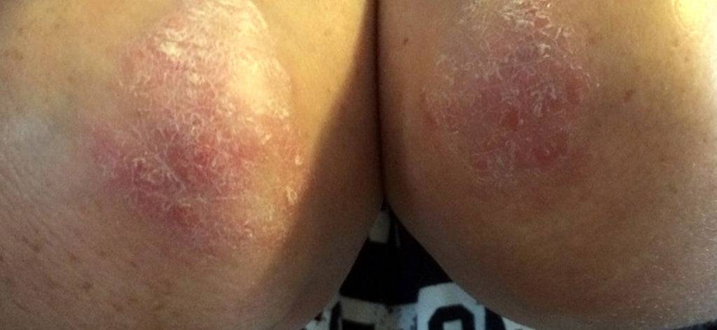Psoriasis? How am I going to deal with this?
